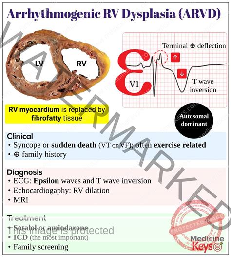 arrhythmogenic right ventricular dysplasia|arrhythmogenic right ventricular dysplasia treatment.